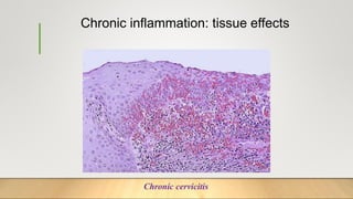 Chronic inflammation: tissue effects
Chronic cervicitis
 