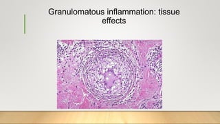 Granulomatous inflammation: tissue
effects
 