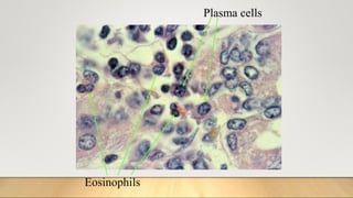 Eosinophils
Plasma cells
 
