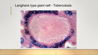 Langhans type giant cell - Tuberculosis
 