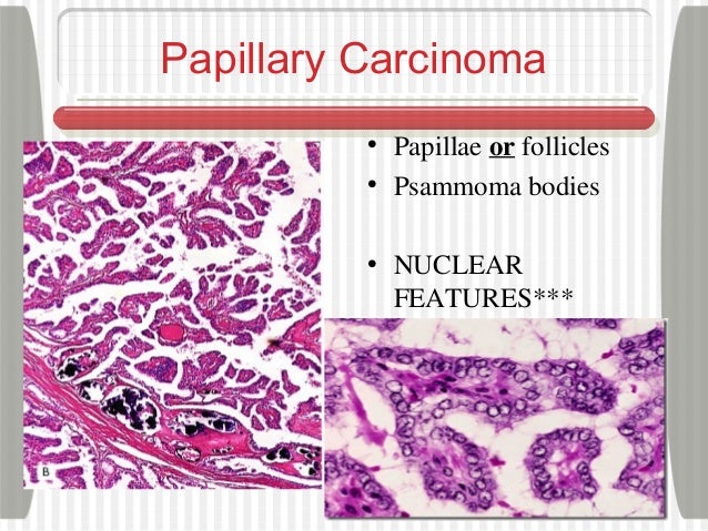 Image result for papillary thyroid carcinoma