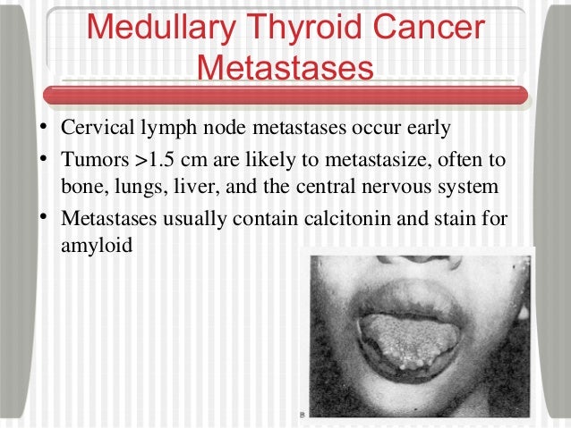 Medullary thyroid carcinoma prognosis grade