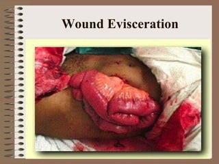 Lect 6  wound mangement