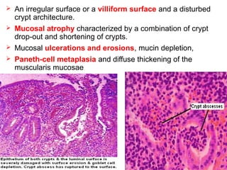  An irregular surface or a villiform surface and a disturbed
crypt architecture.
 Mucosal atrophy characterized by a combination of crypt
drop-out and shortening of crypts.
 Mucosal ulcerations and erosions, mucin depletion,
 Paneth-cell metaplasia and diffuse thickening of the
muscularis mucosae
 
