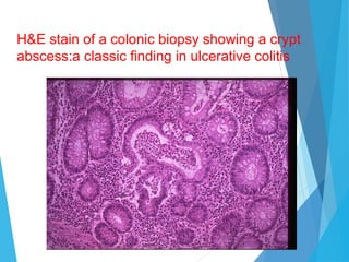 H&E stain of a colonic biopsy showing a crypt
abscess:a classic finding in ulcerative colitis
 