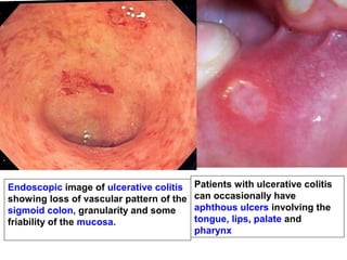 Patients with ulcerative colitis
can occasionally have
aphthous ulcers involving the
tongue, lips, palate and
pharynx
Endoscopic image of ulcerative colitis
showing loss of vascular pattern of the
sigmoid colon, granularity and some
friability of the mucosa.
 