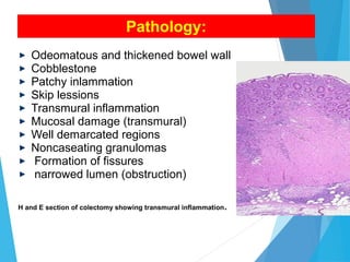 Pathology:
Odeomatous and thickened bowel wall
Cobblestone
Patchy inlammation
Skip lessions
Transmural inflammation
Mucosal damage (transmural)
Well demarcated regions
Noncaseating granulomas
Formation of fissures
narrowed lumen (obstruction)
H and E section of colectomy showing transmural inflammation.
 