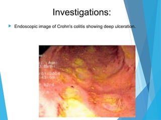 Investigations:
 Endoscopic image of Crohn's colitis showing deep ulceration.
 