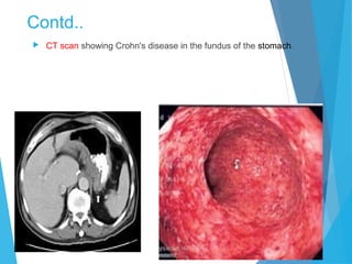 Contd..
 CT scan showing Crohn's disease in the fundus of the stomach.
 