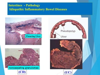 Intestines - Pathology
Idiopathic Inflammatory Bowel Diseases
(CD) (UC)
Fissuring Ulcer
noncaseating granulomas
 