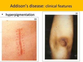 adrenal glands disorder | PPT
