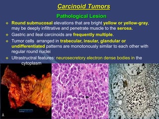 Tumors of intestine | PPTX