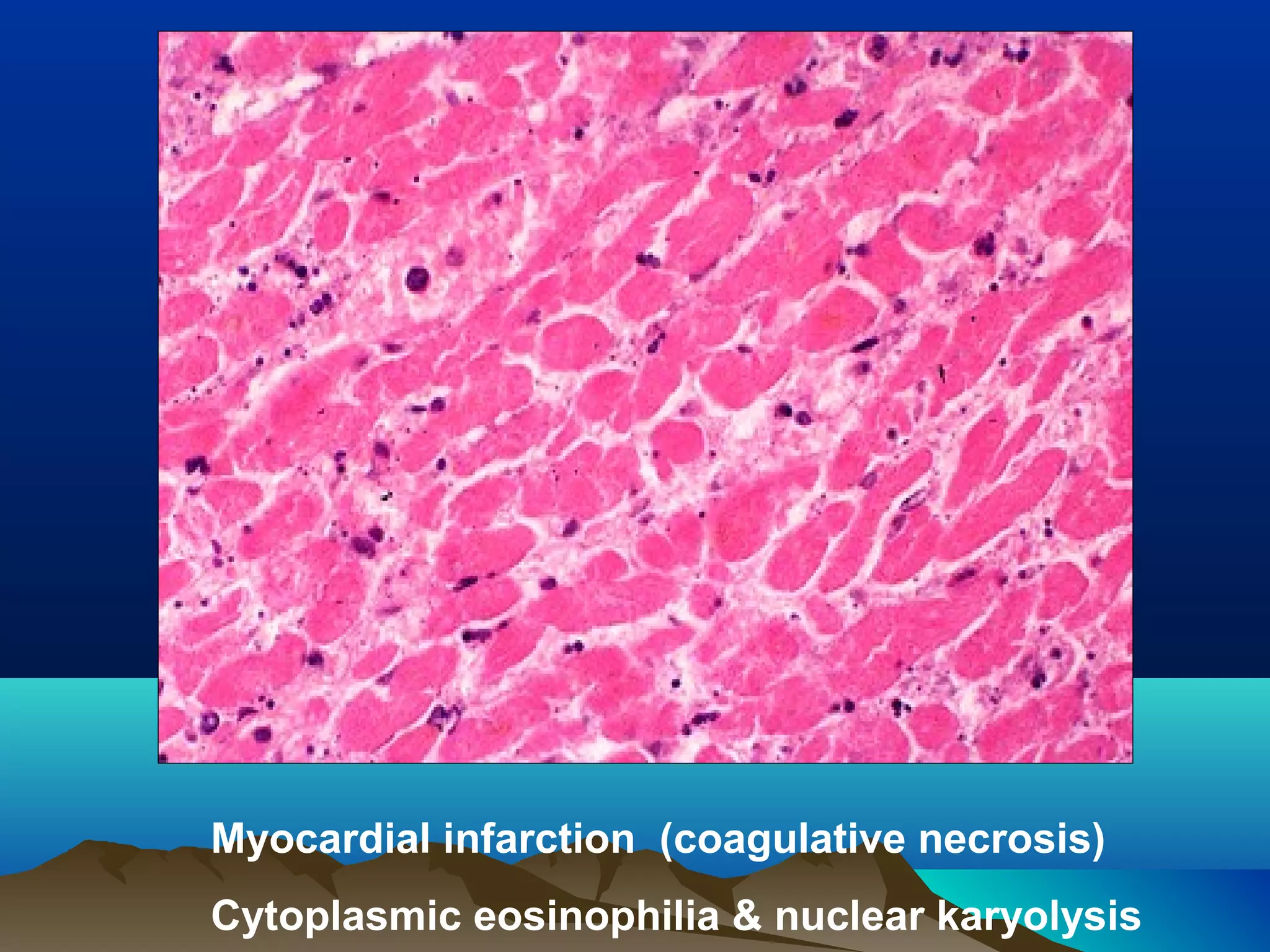 Myocardial infarction (coagulative necrosis)
Cytoplasmic eosinophilia & nuclear karyolysis
 