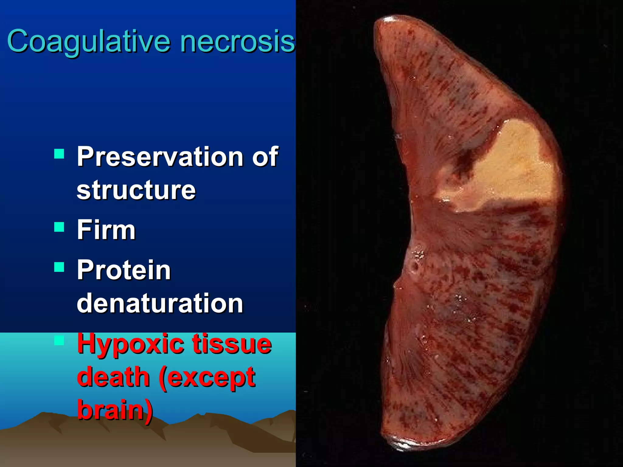 Coagulative necrosis


      Preservation of
       structure
      Firm
      Protein
       denaturation
      Hypoxic tissue
       death (except
       brain)
 