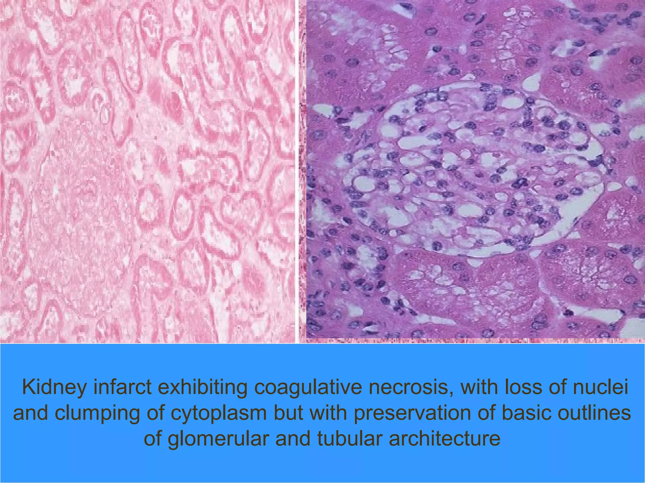 Kidney infarct exhibiting coagulative necrosis, with loss of nuclei
and clumping of cytoplasm but with preservation of basic outlines
              of glomerular and tubular architecture
 