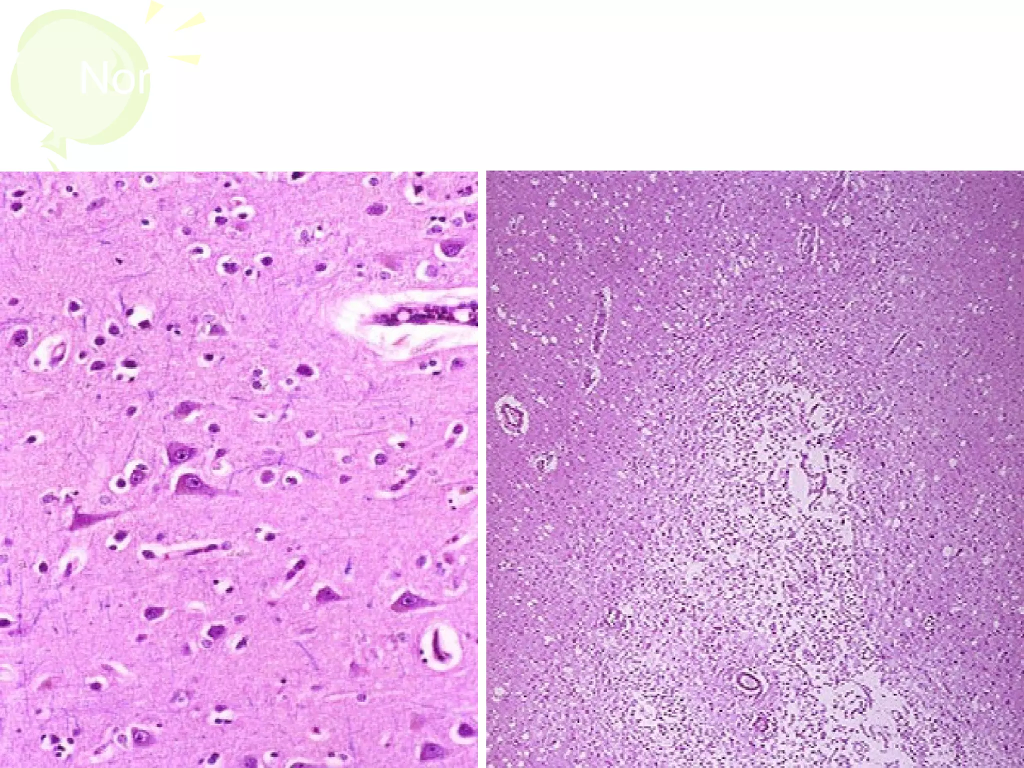 Normal brain   Liquefactive necrosis
 