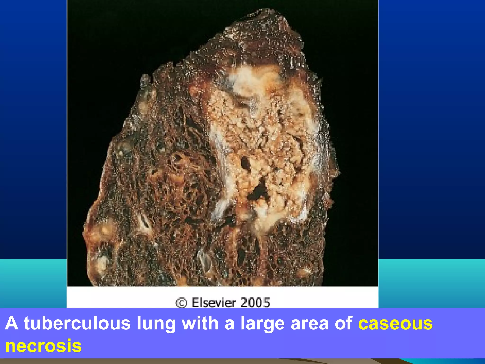 A tuberculous lung with a large area of caseous
necrosis
 