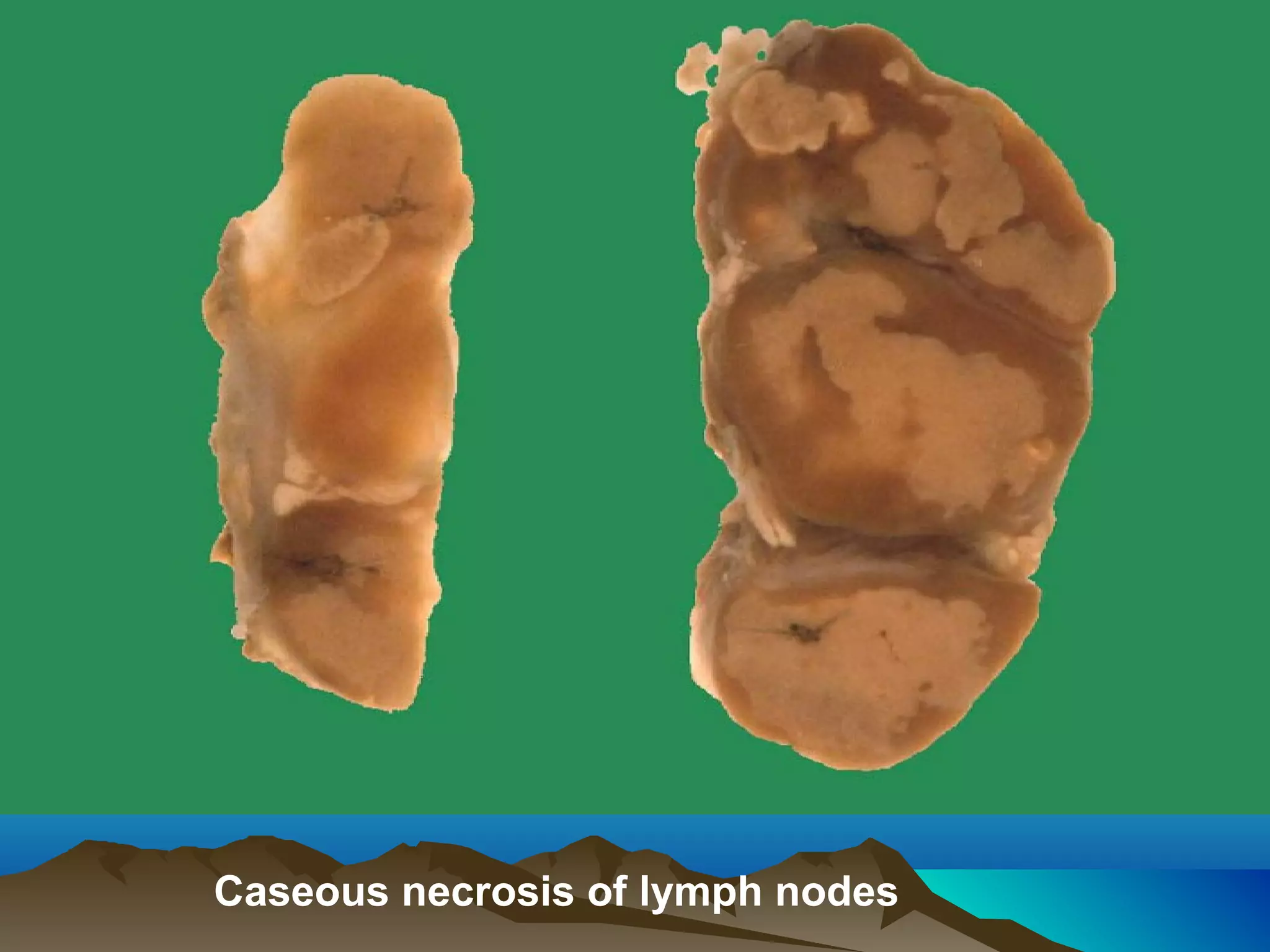 Caseous necrosis of lymph nodes
 
