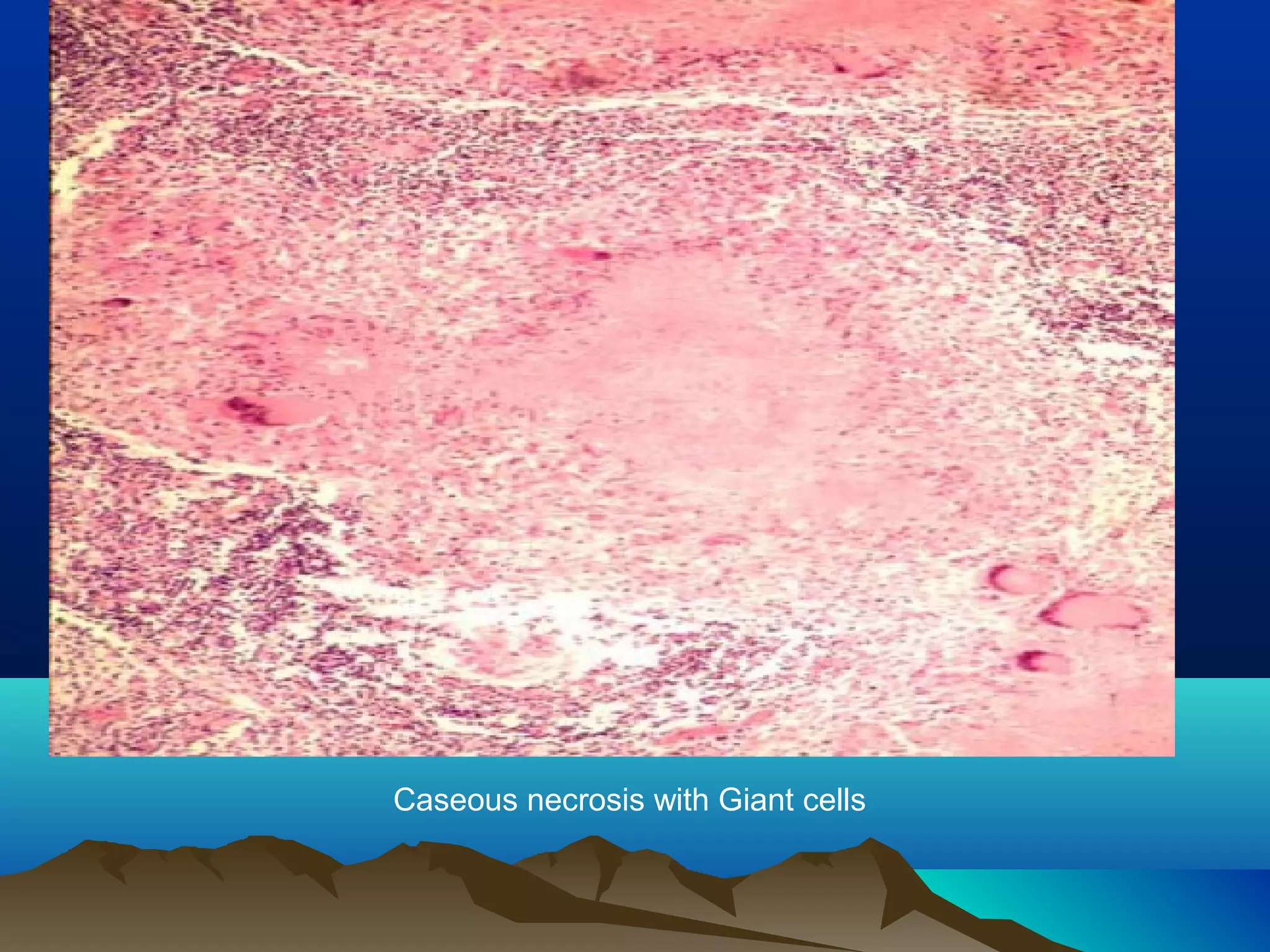 Caseous necrosis with Giant cells
 