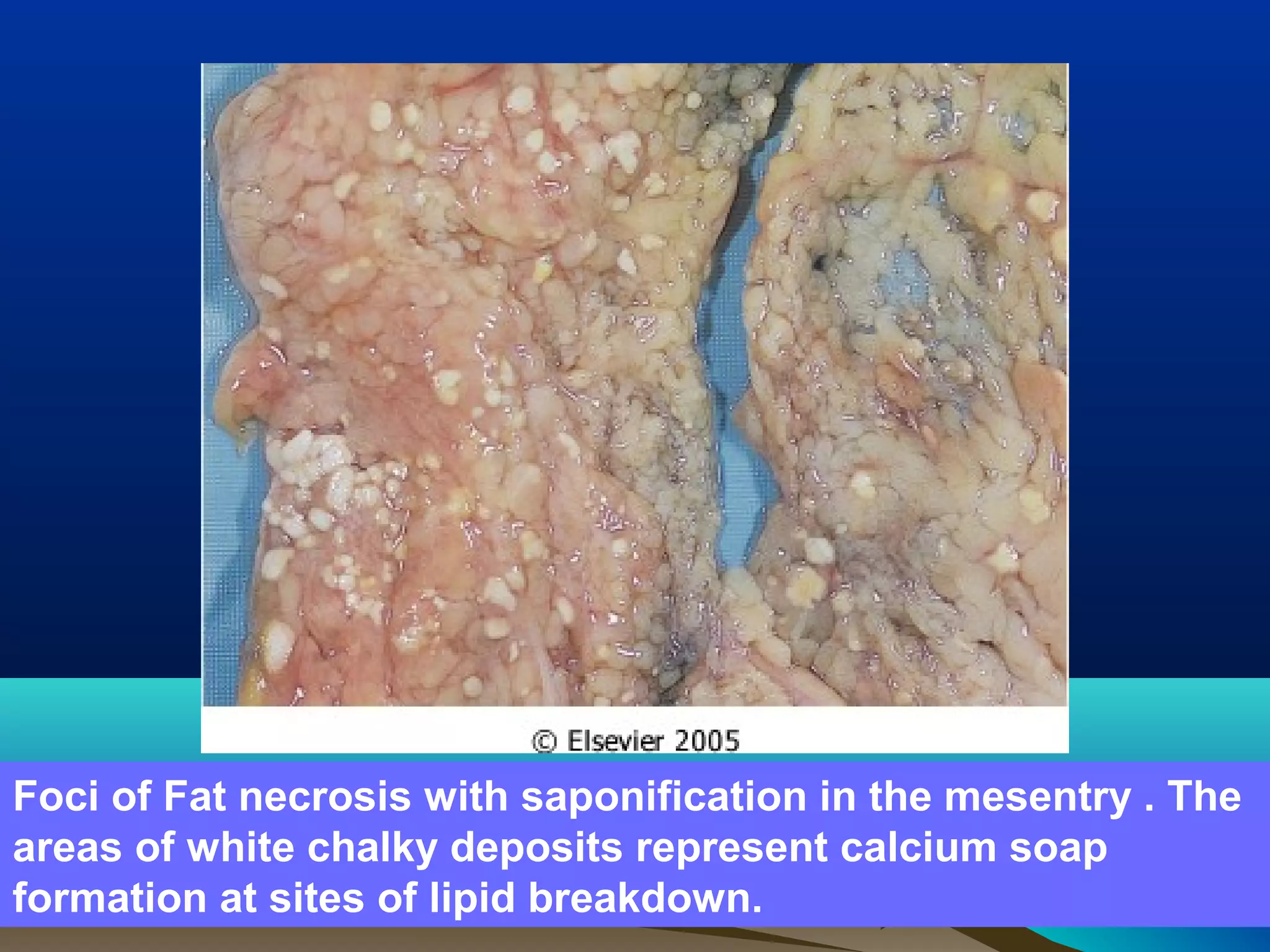Foci of Fat necrosis with saponification in the mesentry . The
areas of white chalky deposits represent calcium soap
formation at sites of lipid breakdown.
 