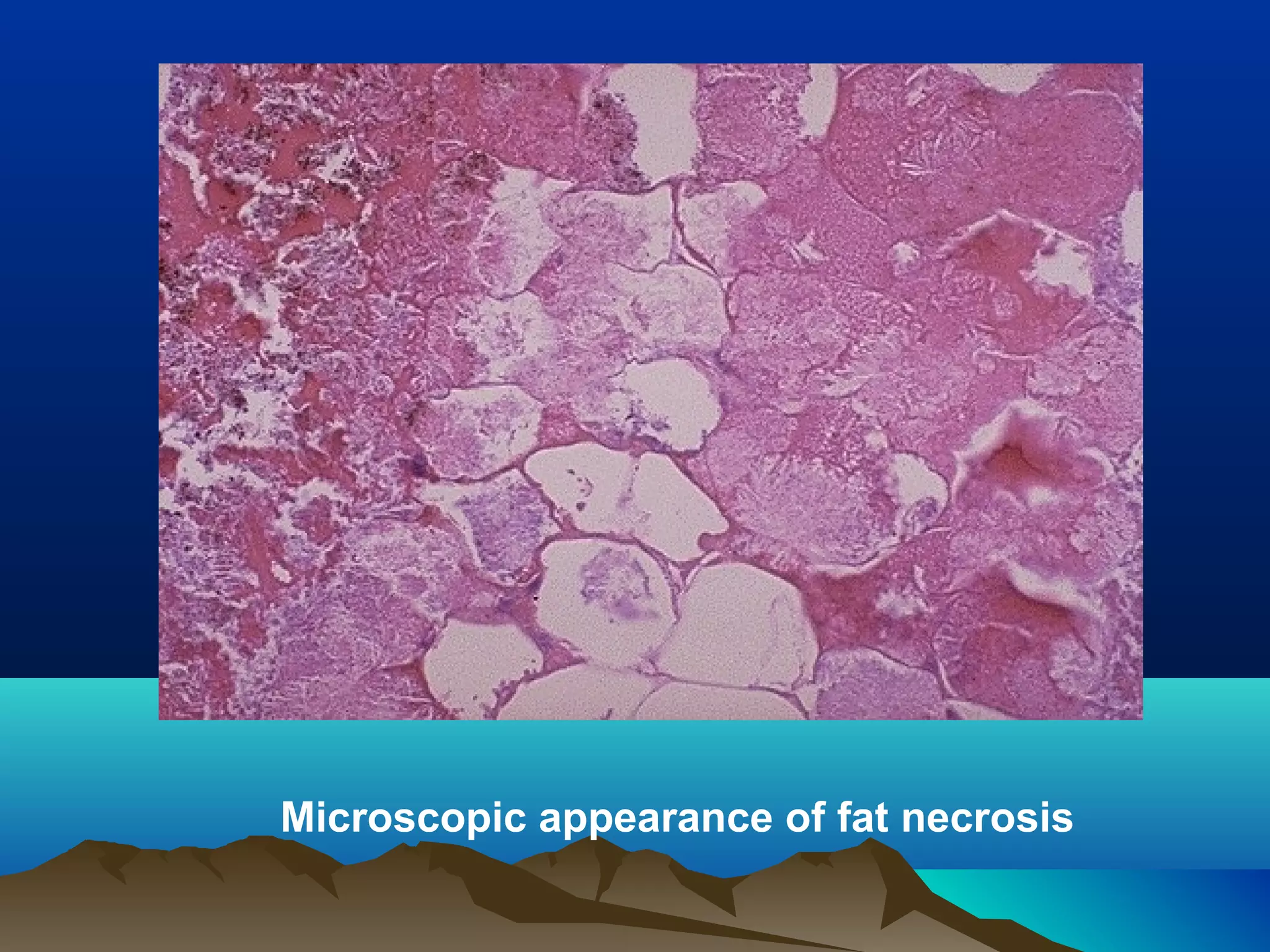 Microscopic appearance of fat necrosis
 