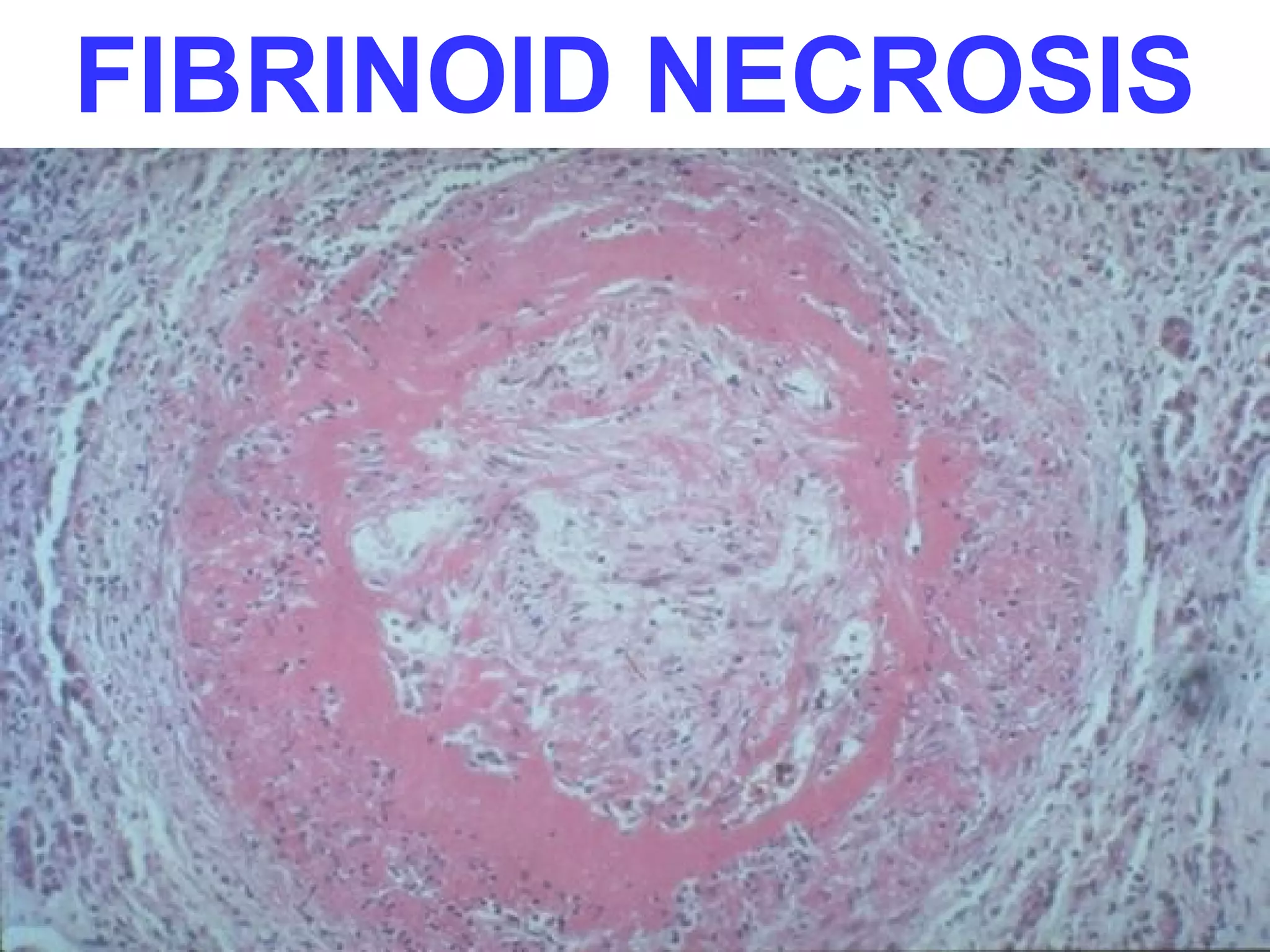 FIBRINOID NECROSIS
 