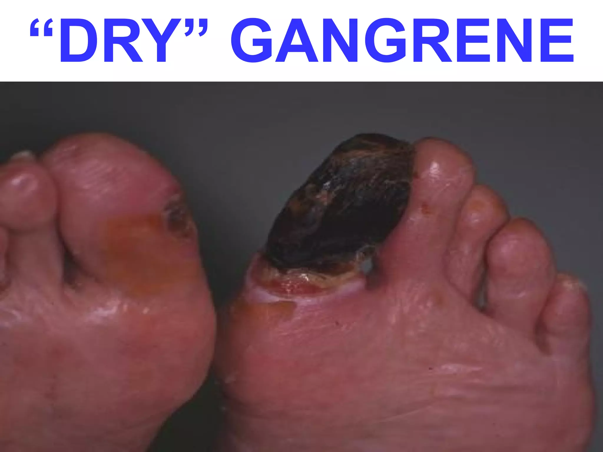 “DRY” GANGRENE
 