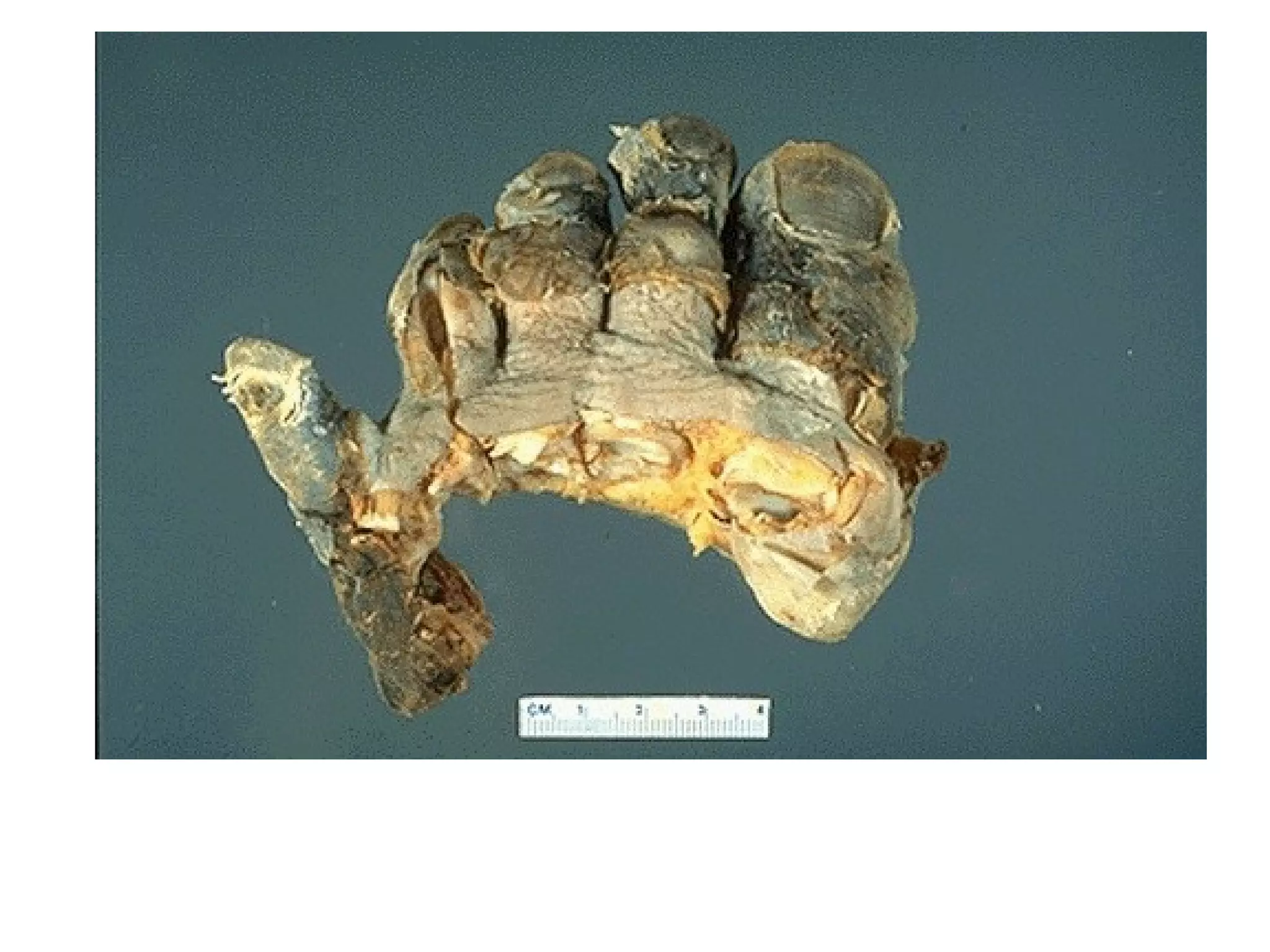 dry gangrene (coagulative necrosis)
 
