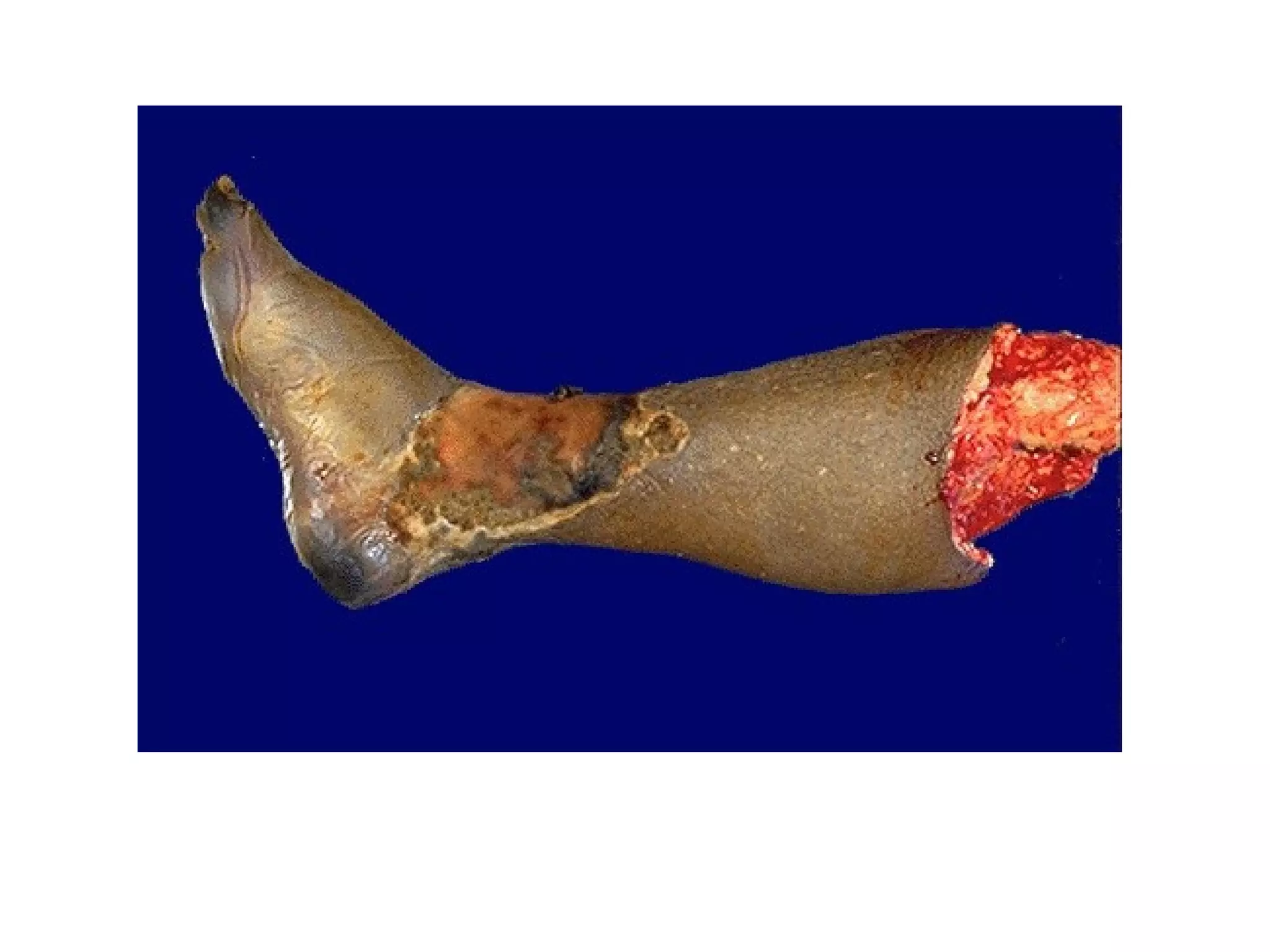 "wet   gangrene in patient with Diabetes
                millitus”
 