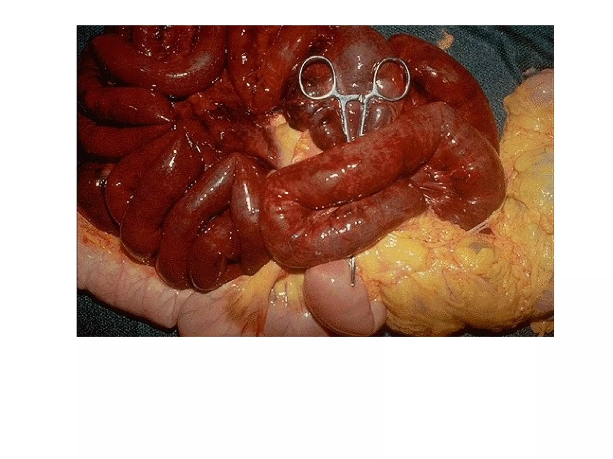 Ischemic necrosis of the bowel (bowel infarction)
 