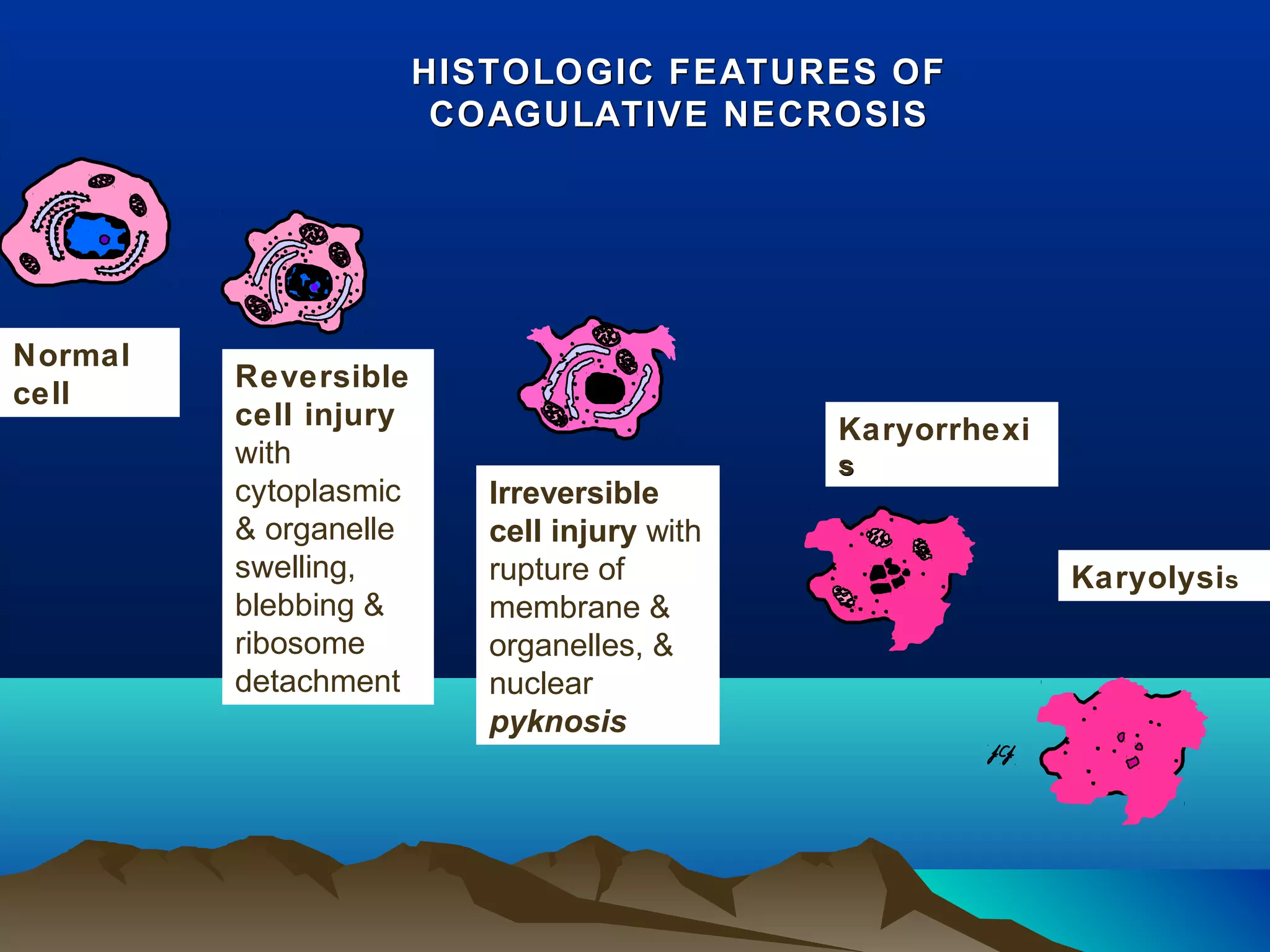 HISTOLOGIC FEATURES OF
                        COAGULATIVE NECROSIS




Normal
         Reversible
cell
         cell injury                         Karyorrhexi
         with                                s
         cytoplasmic      Irreversible
         & organelle      cell injury with
         swelling,        rupture of                       Karyolysis
         blebbing &       membrane &
         ribosome         organelles, &
         detachment       nuclear
                          pyknosis
 