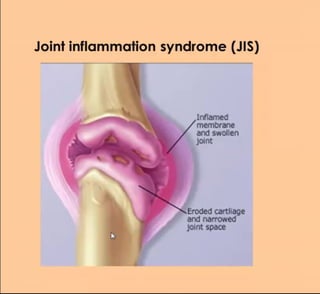 Joint inflammation syndrome (JIS)
Inflamed
membrane
and swollen
joint
Eroded cartliage
and narrowed
joint space
 
