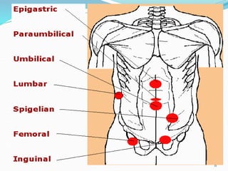 Lecture no. 11. Hernias.ppt Adult Health | PPT