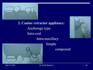 2. Canine retractor appliance:
Anchorage type:
Intra-oral
Intra-maxillary
Simple
compound

May 22, 2012

Dr. Ahmed Basyouni

20

 
