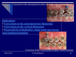 Correction in the anteroposterior plane of space: molar protraction

Indications:
• Corrections in the anteroposterior dimension
• Corrections in the vertical dimension
• Preprosthetic orthodontics, single tooth movement,
and mutilated dentition

Correction in the vertical plane of space: molar intrusion
May 22, 2012

Dr. Ahmed Basyouni

29

 