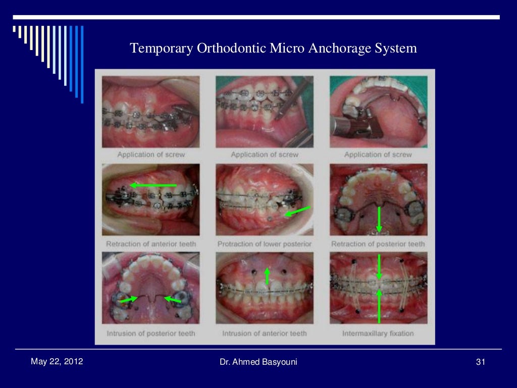 Anchorage in Orthodontics