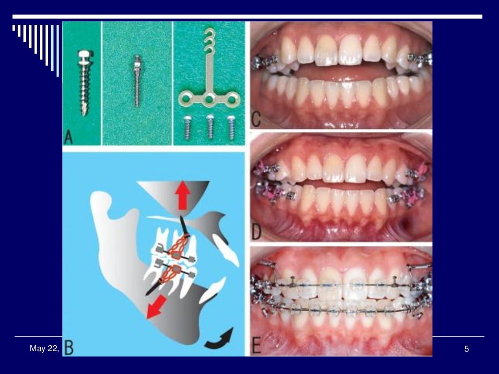 Anchorage in Orthodontics
