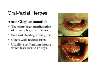 Oral-facial Herpes
Acute Gingivostomatitis
• The commonest manifestation
of primary herpetic infection
• Pain and bleeding of the gums
• Ulcers with necrotic bases
• Usually a self limiting disease
which lasts around 13 days.
 