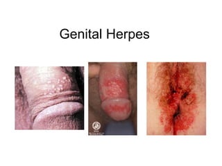 Genital Herpes
 