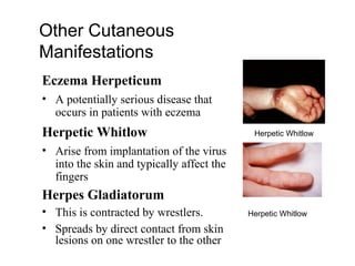 Other Cutaneous
Manifestations
Eczema Herpeticum
• A potentially serious disease that
occurs in patients with eczema
Herpetic Whitlow
• Arise from implantation of the virus
into the skin and typically affect the
fingers
Herpes Gladiatorum
• This is contracted by wrestlers.
• Spreads by direct contact from skin
lesions on one wrestler to the other
Herpetic Whitlow
Herpetic Whitlow
 