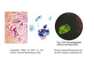 Cytopathic Effect of HSV in cell
culture: Note the ballooning of cells.
Positive immunofluorescence test
for HSV antigen in epithelial cell.
 