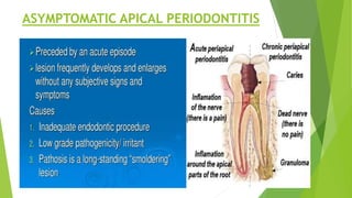 ASYMPTOMATIC APICAL PERIODONTITIS
 