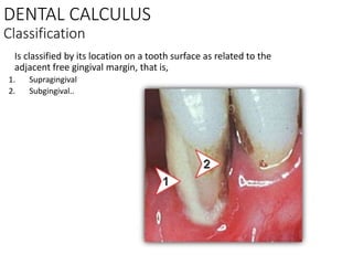LECT 4 DENTAL CALCULUS INCLUDING FORMATION AND CAUSES.pptx