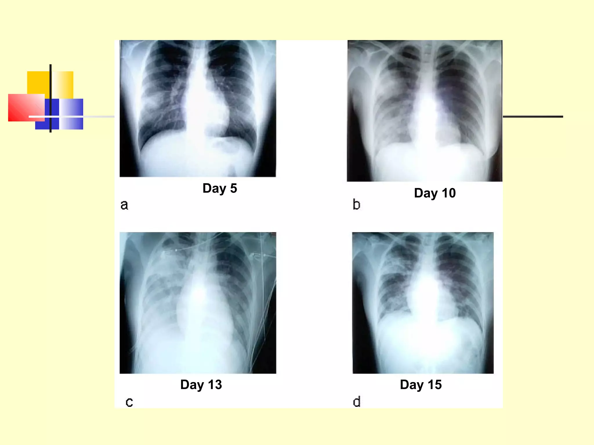 Day 5 Day 10
Day 13 Day 15
 