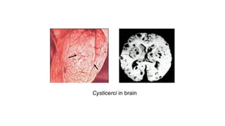 Cysticerci in brain
 