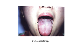 Cysticerci in tongue
 
