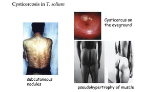 subcutaneous
nodules
Cysticercus on
the eyeground
pseudohypertrophy of muscle
Cysticercosis in T. solium
 