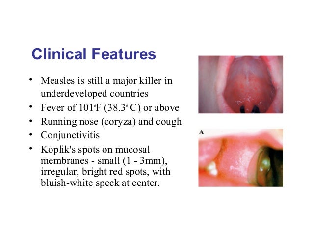 Lect 6 a measles, mumps and rubella