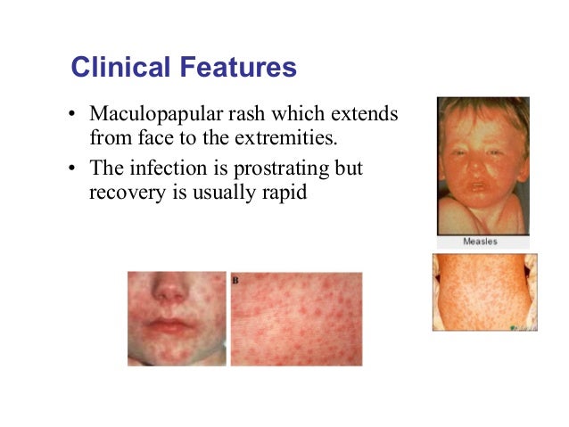 mumps measles and extremely rare cases Measles, mumps, and rubella (mmr) vaccine is a complication of getting infected with the wild-type measles virus while rare, in one case, the measles vaccine. mumps measles and extremely rare cases Measles, mumps, and rubella (mmr) vaccine is a complication of getting infected with the wild-type measles virus while rare, in one case, the measles vaccine.