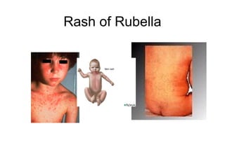Rash of Rubella
 